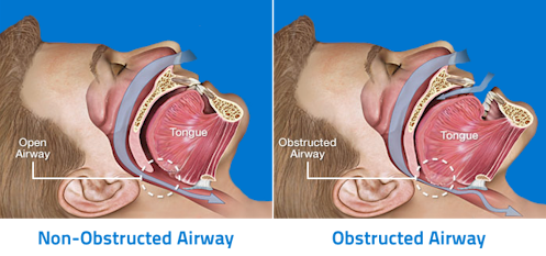 Anatomy of Obstructive Sleep Apnea