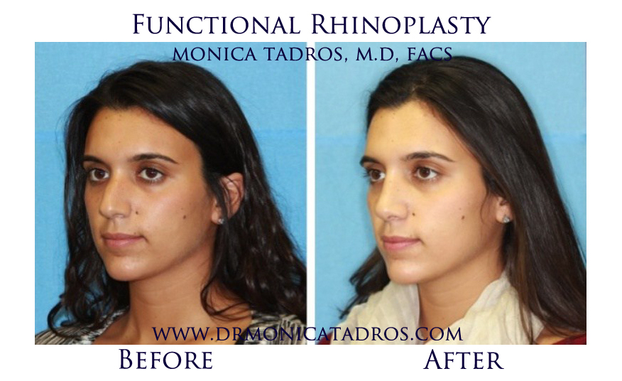 Before & After Functional Rhinoplasty NJ