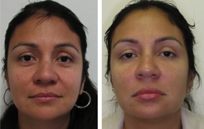 Facial Filler Injections Gallery
