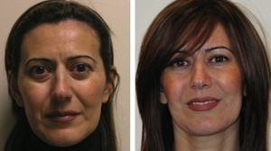 Facial Filler Injections Gallery