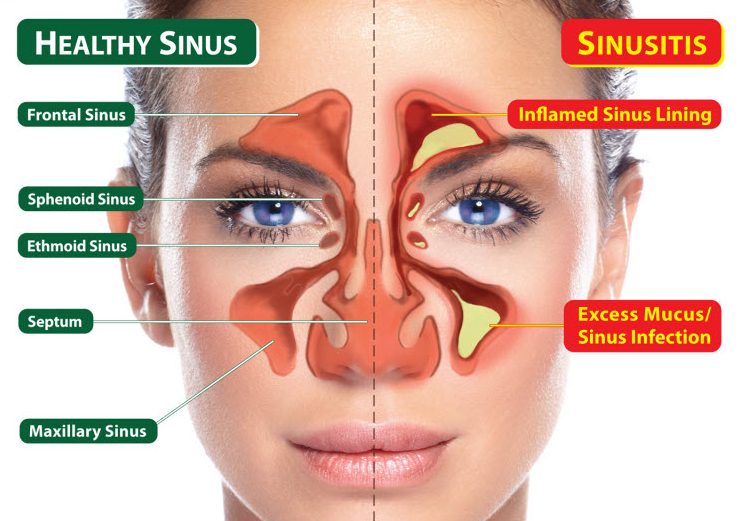 healthy-sinus-vs-sinusitis
