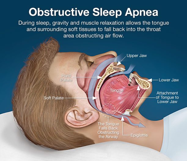 Diagnosis and Treatment of Obstructive Sleep Apnea