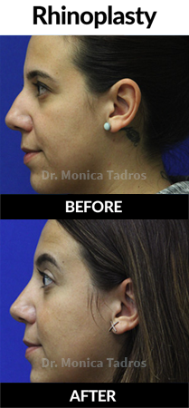 Rhinoplasty Procedure in NYC | Before and After