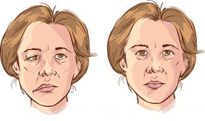 Facial Paralysis Surgery