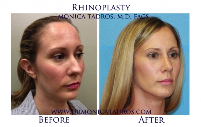 Average Cost of Rhinoplasty in New Jersey | Dr. Monica Tadros