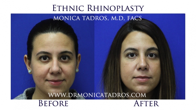 Ethnic Rhinoplasty (Nose Job) Surgery in NJ
