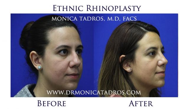 Ethnic Rhinoplasty (Nose Job) Surgery in NJ