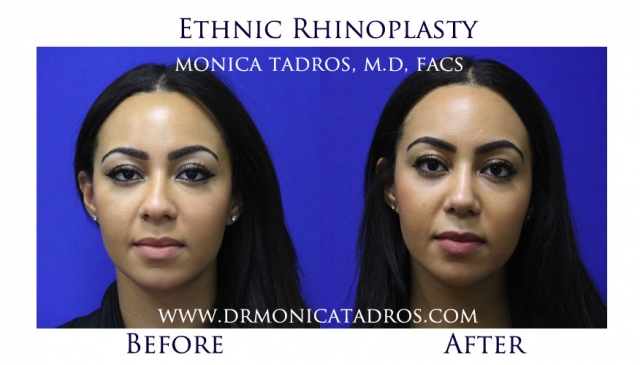 ethnic liquid rhinoplasty ethnic liquid rhinoplasty