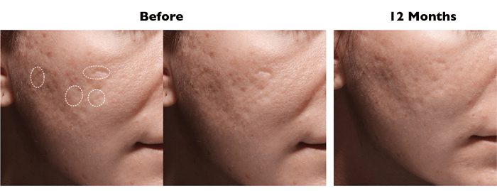 before-after-photos-bellafill-acne-scars-nj-02