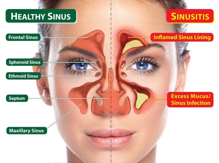 Sinus infection hot sale