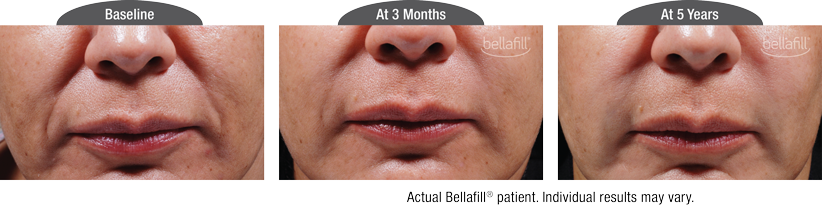 bellafill-smile-lines-before-after-nj