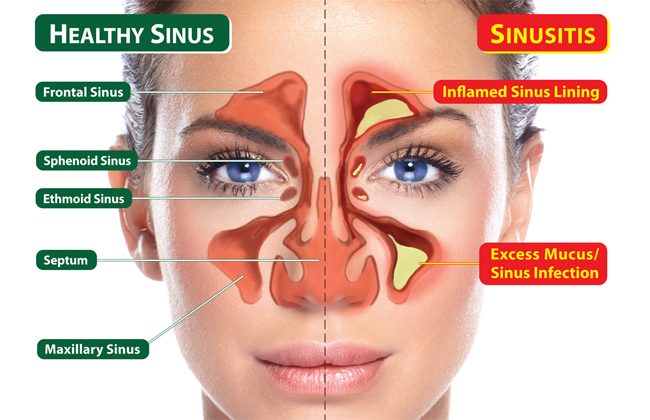 sinus treatment