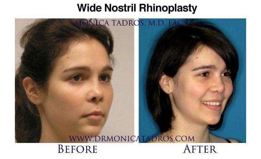 wide-nostril-rhinoplasty-nj