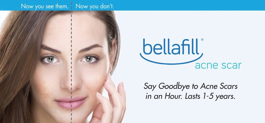 bellafill-acne-scars-nyc