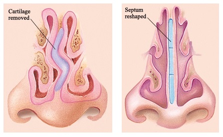 Deviated Septum Surgery in Englewood NJ & NYC