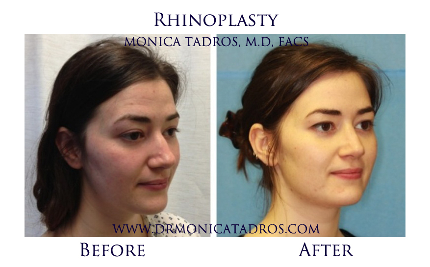 1Rhinoplasty-NJ-before-after-photo-005