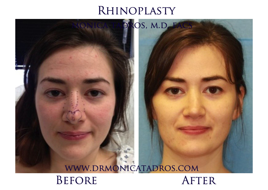 1Rhinoplasty-NJ-before-after-photo-015