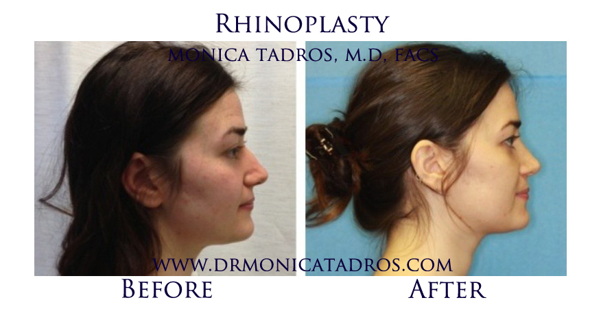1Rhinoplasty-NJ-before-after-photo-016