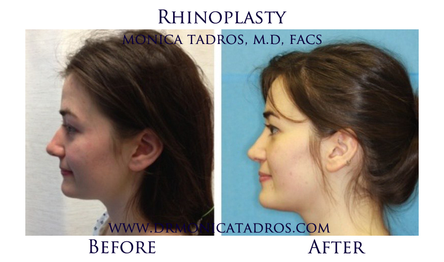 1Rhinoplasty-NJ-before-after-photo-017