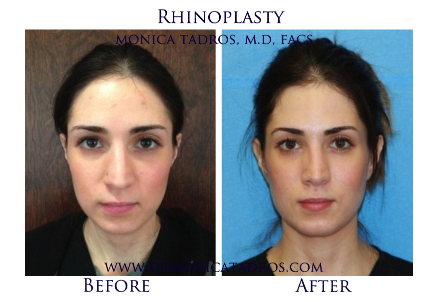 2Rhinoplasty-NJ-before-after-photo-020