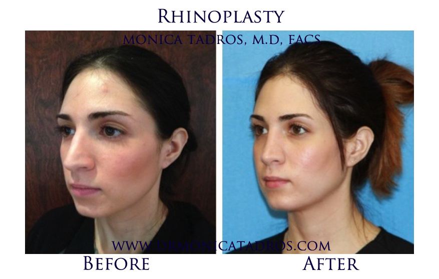 2Rhinoplasty-NJ-before-after-photo-021
