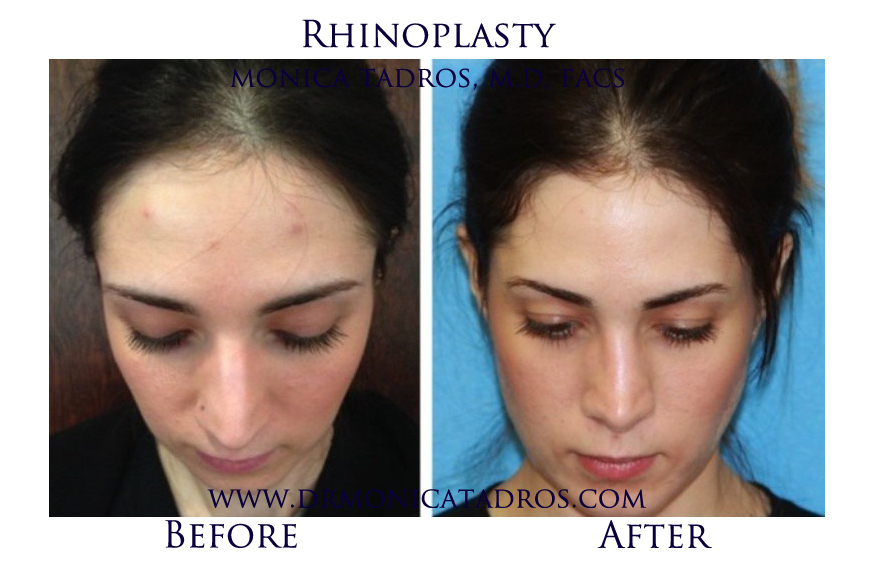 Rhinoplasty Before & After E Dr. Monica Tadros Sinus, Sleep & Facial Plastic Surgery NJ