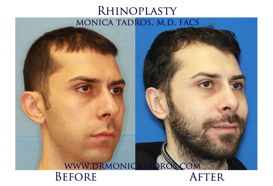 3Rhinoplasty-NJ-before-after-photo-024