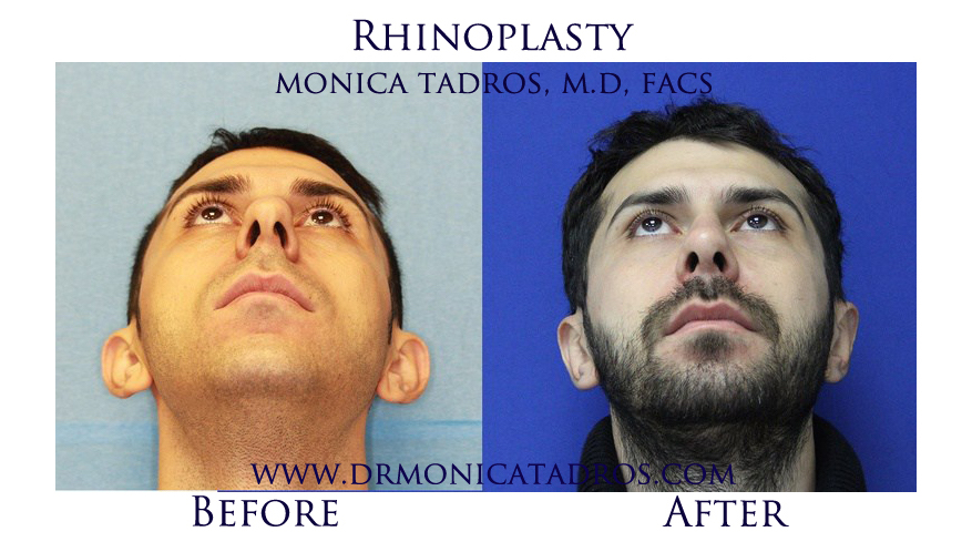 3Rhinoplasty-NJ-before-after-photo-026