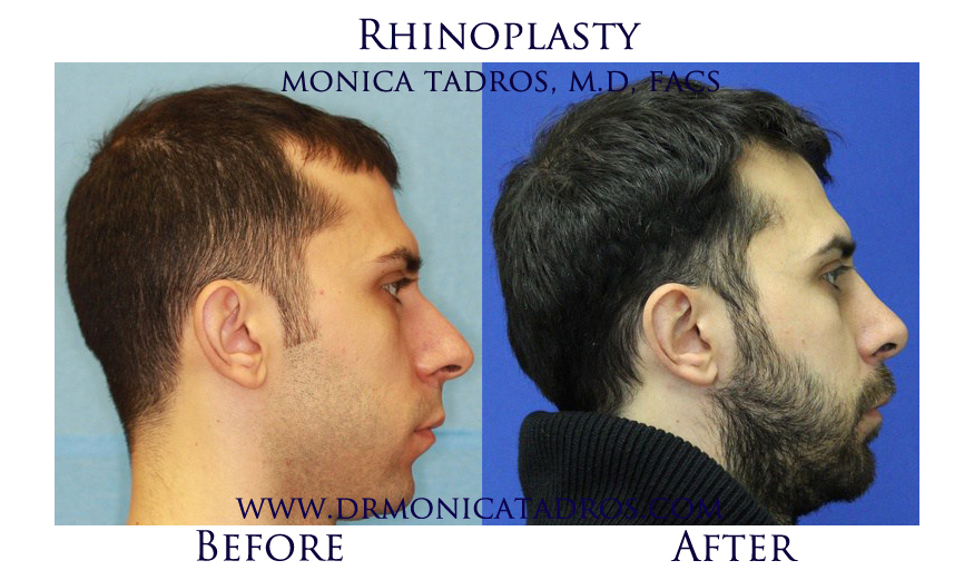 3Rhinoplasty-NJ-before-after-photo-027