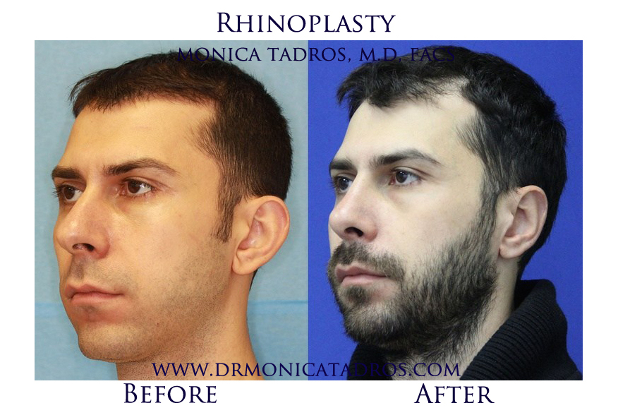 3Rhinoplasty-NJ-before-after-photo-028