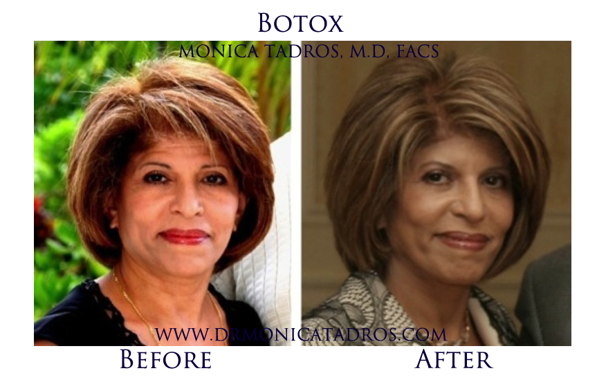 Botox-NJ-before-after-photo-001