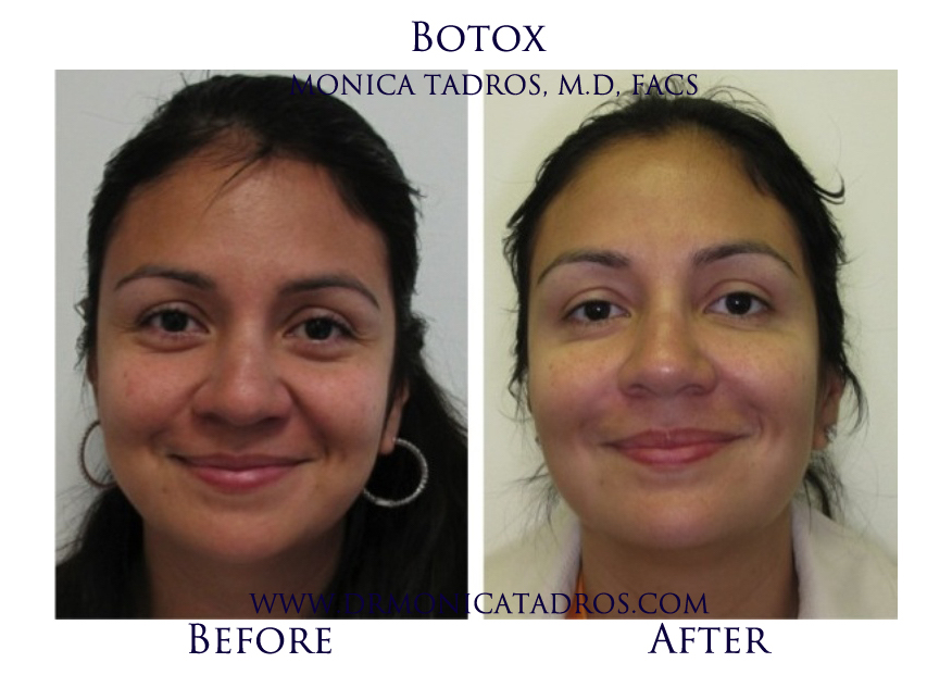Botox-NJ-before-after-photo-001.jpg