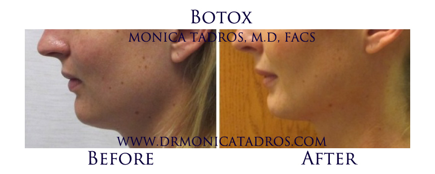 Botox-NJ-before-after-photo-002