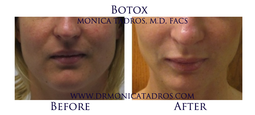 Botox-NJ-before-after-photo-003