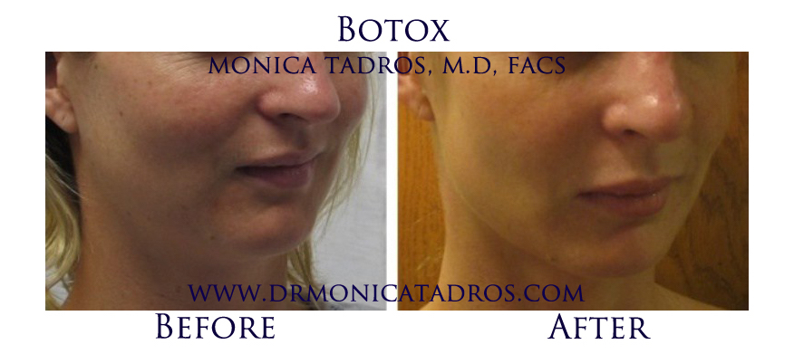 Botox-NJ-before-after-photo-005