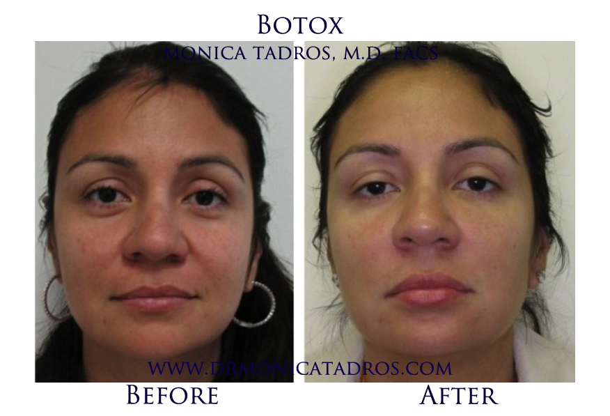Botox-NJ-before-after-photo-006