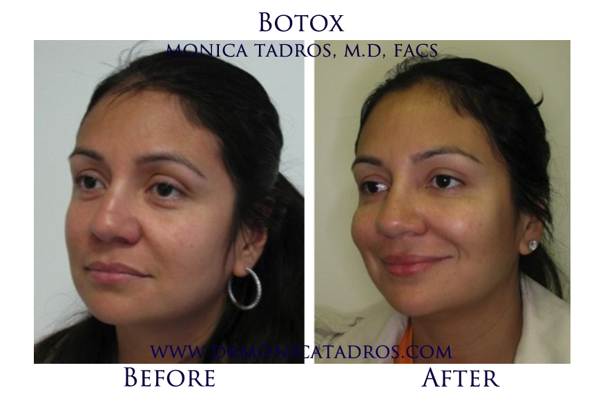 Botox-NJ-before-after-photo-007