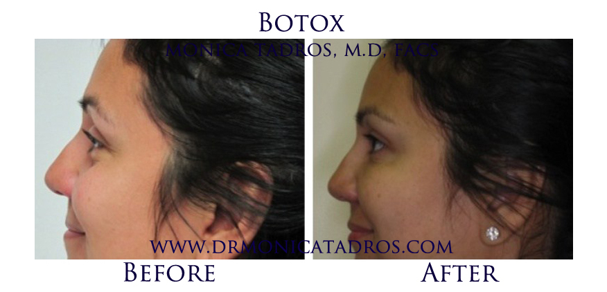 Botox-NJ-before-after-photo-008
