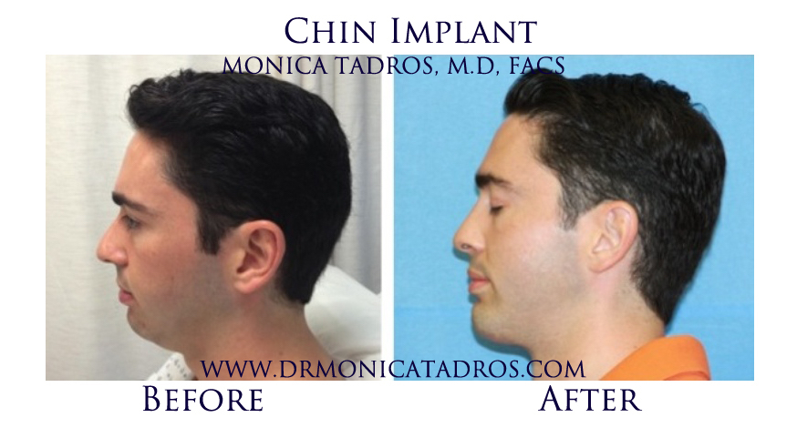 Chin-Implant-NJ-before-after-photo-001