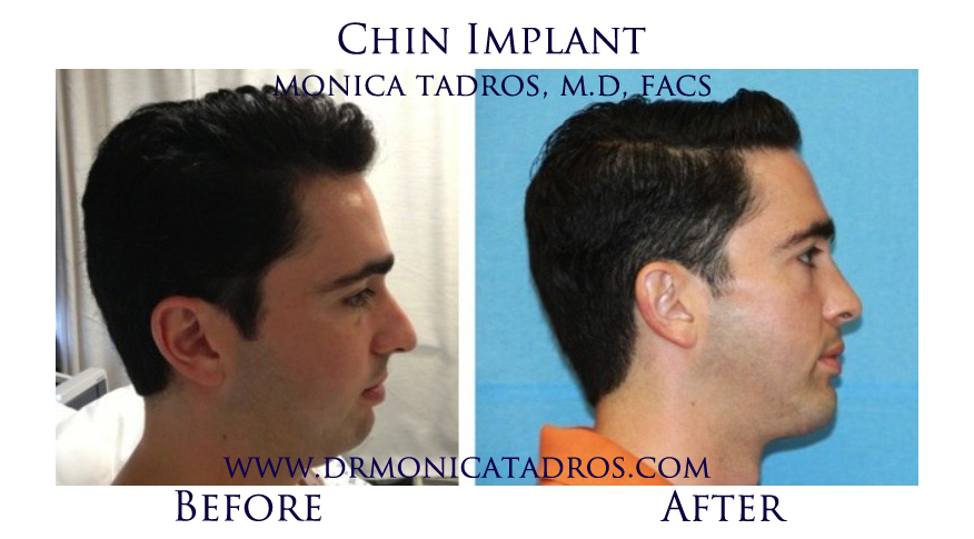 Chin-Implant-NJ-before-after-photo-003