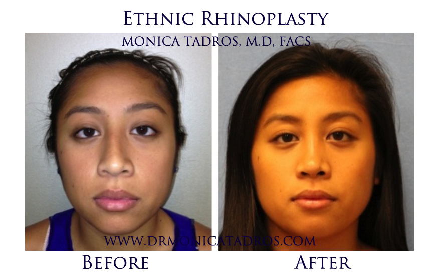 Ethnic Rhinoplasty in New Jersey Before & After