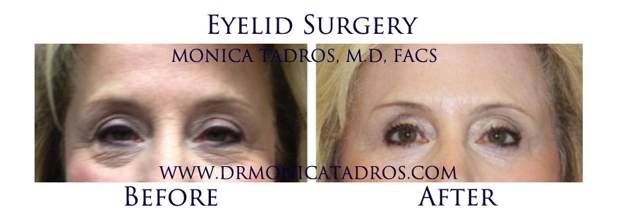Eyelid-Surgery-NJ-before-after-photo-001