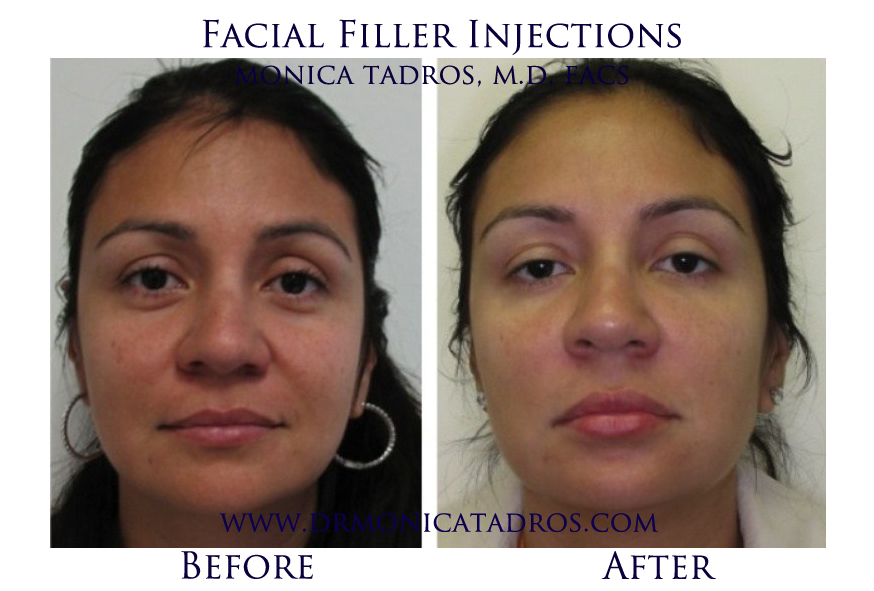 Facial Filler Injections NJ Before After