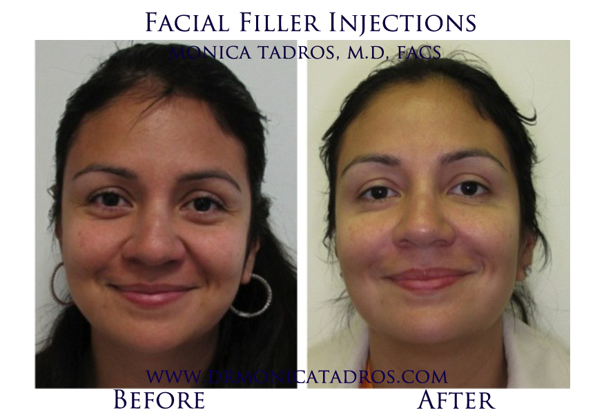 Facial-Filler-Injections-NJ-before-after-photo-007