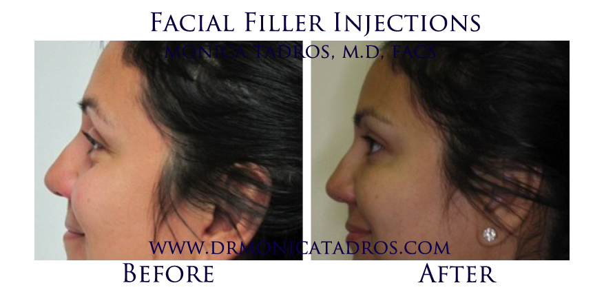 Facial-Filler-Injections-NJ-before-after-photo-008