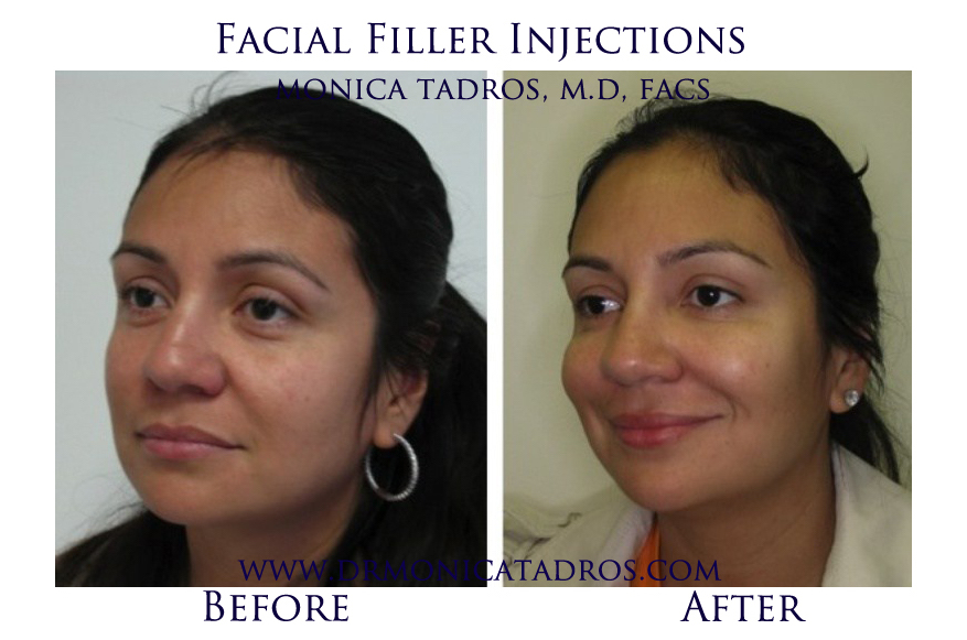 Facial-Filler-Injections-NJ-before-after-photo-009