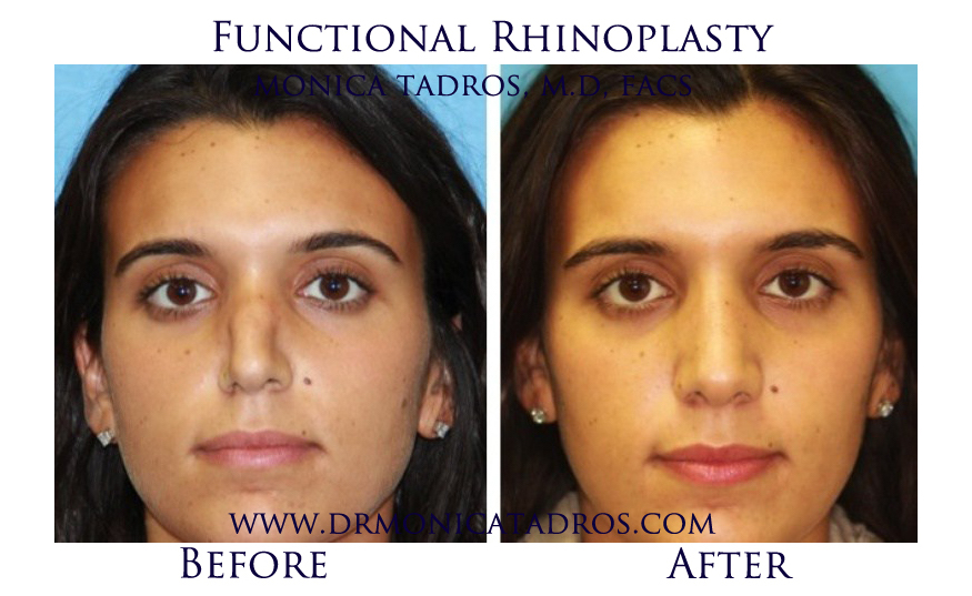 Functional-Rhinoplasty-NJ-before-after-photo-003