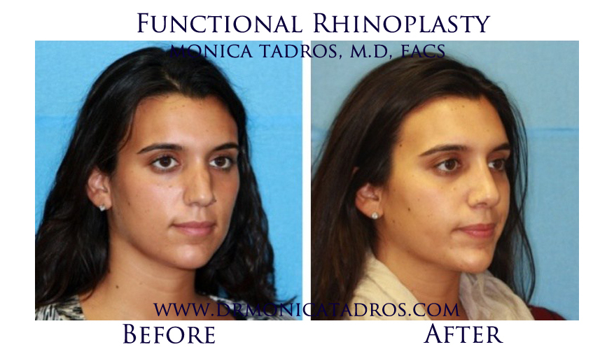 Functional-Rhinoplasty-NJ-before-after-photo-005