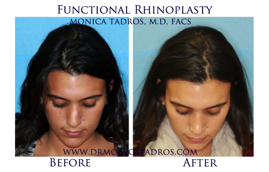 Functional-Rhinoplasty-NJ-before-after-photo-008