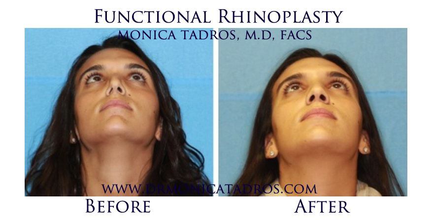 Functional-Rhinoplasty-NJ-before-after-photo-009